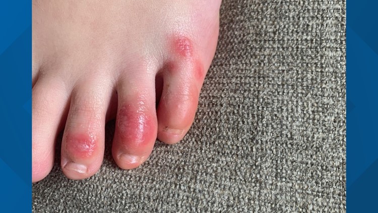 What Are COVID Toes Skin Condition May Be Linked To Coronavirus Wbir Com   C8e06ed3 A8b2 4ce8 9fbe 107398063171 750x422 