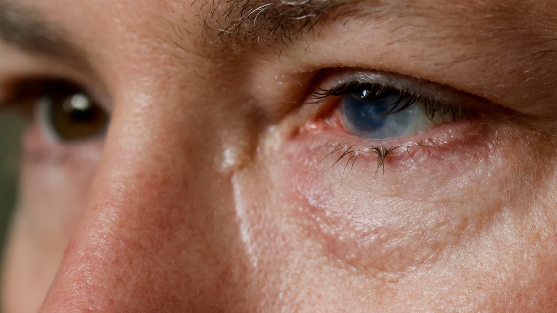 Stem cells from one eye could help healing injuries in the other - Vimarsana News