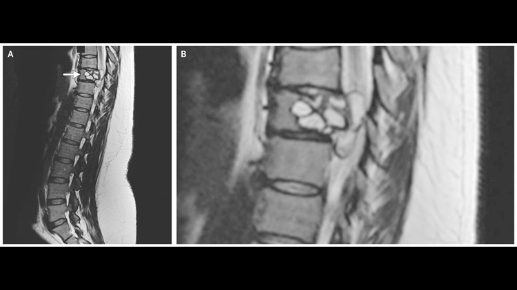 Vertebral Hydatidosis Vertebral Hydatidosis