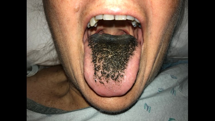 A case of black hairy tongue.