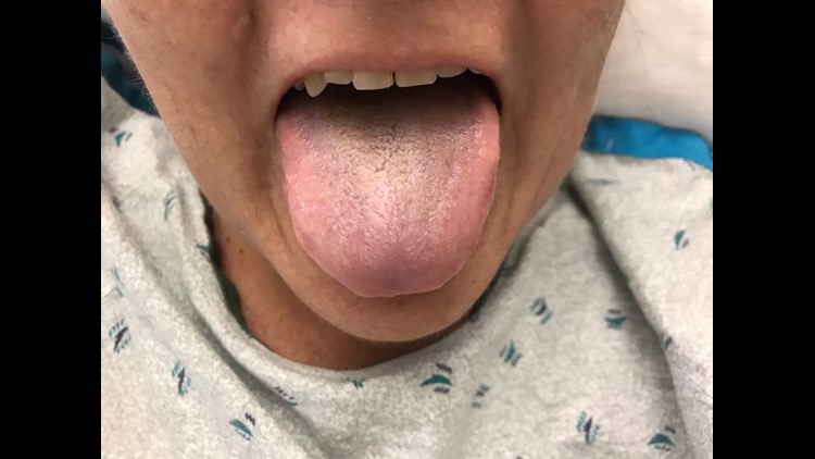 A woman treated with antibiotics developed a condition called black hairy tongue. After changing treatment, her tongue returned to normal.