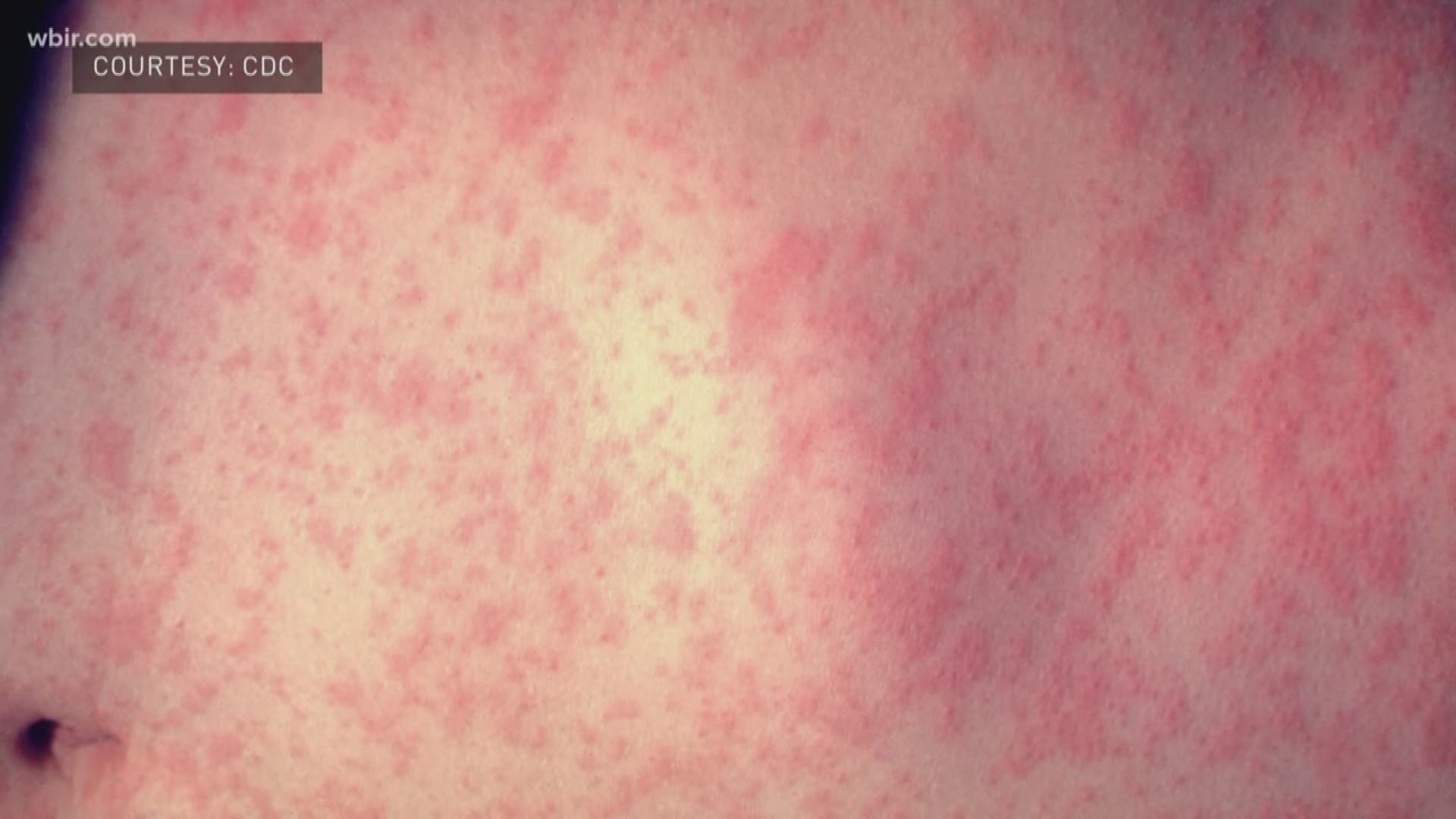 A measles outbreak is spreading across 21 states, including Tennessee.