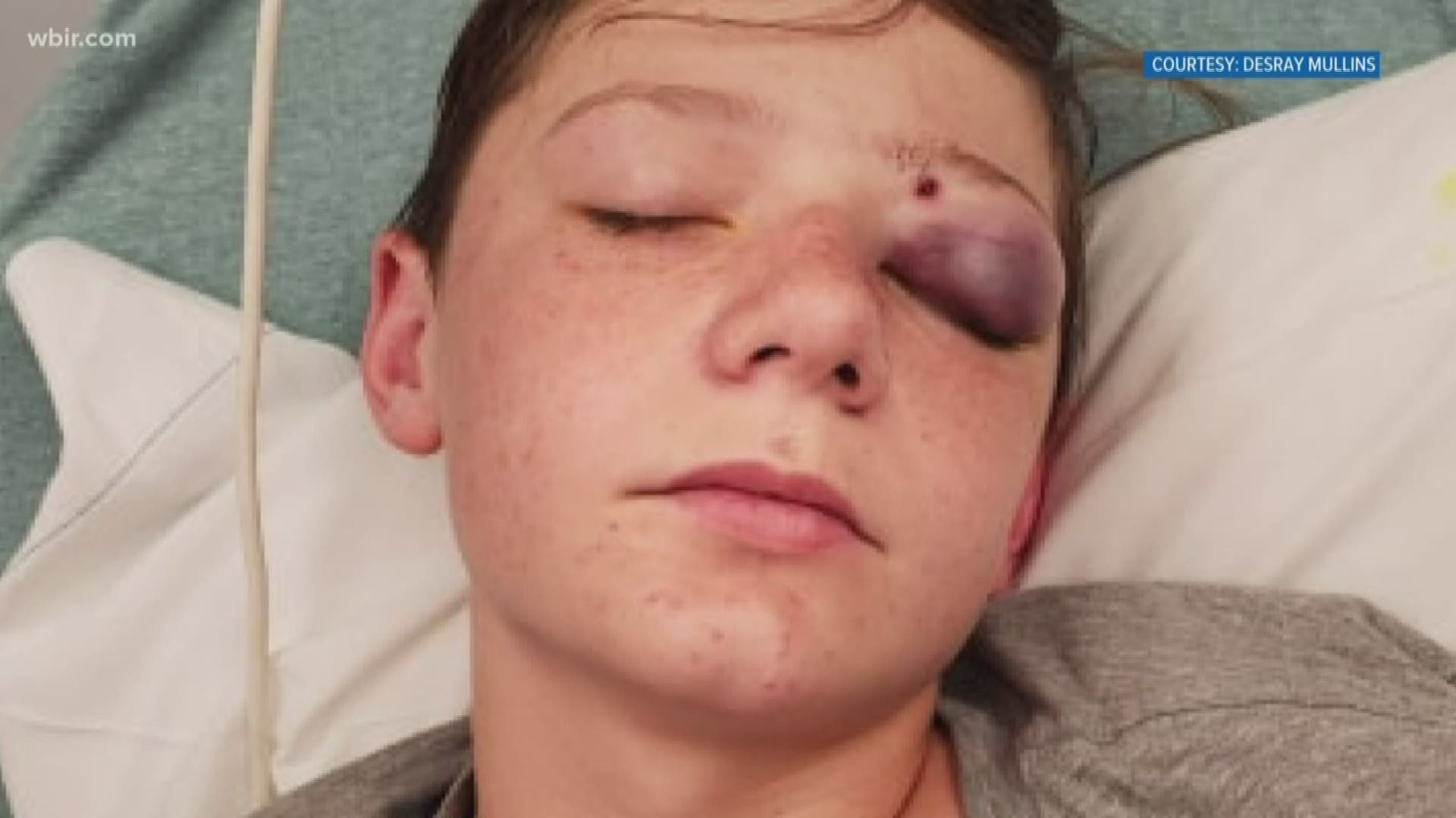 A Morristown teen will recover after being shot in the head with a BB gun, but the BB will remain lodged in his brain because surgery is too risky.