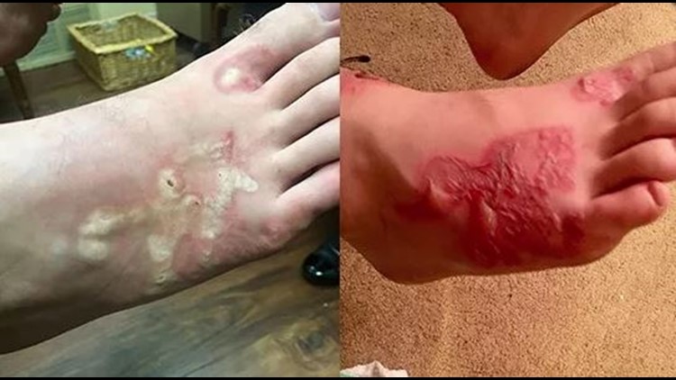Hookworms Burrowed Into Teen's Skin On Trip. You Can't Unsee These