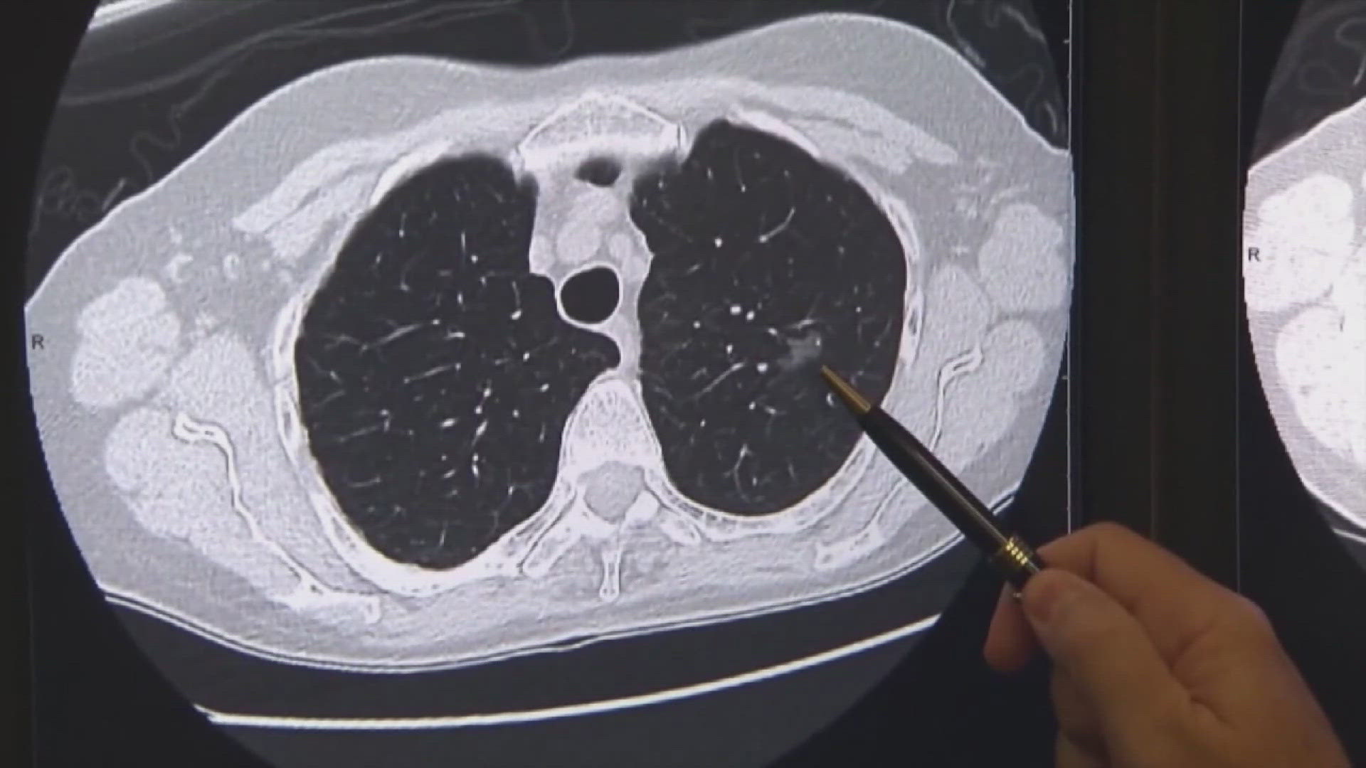 Dr. Sean Jordan, a thoracic surgeon at the University of Tennessee Medical Center, said the medication helps save the healthy part of the lung.