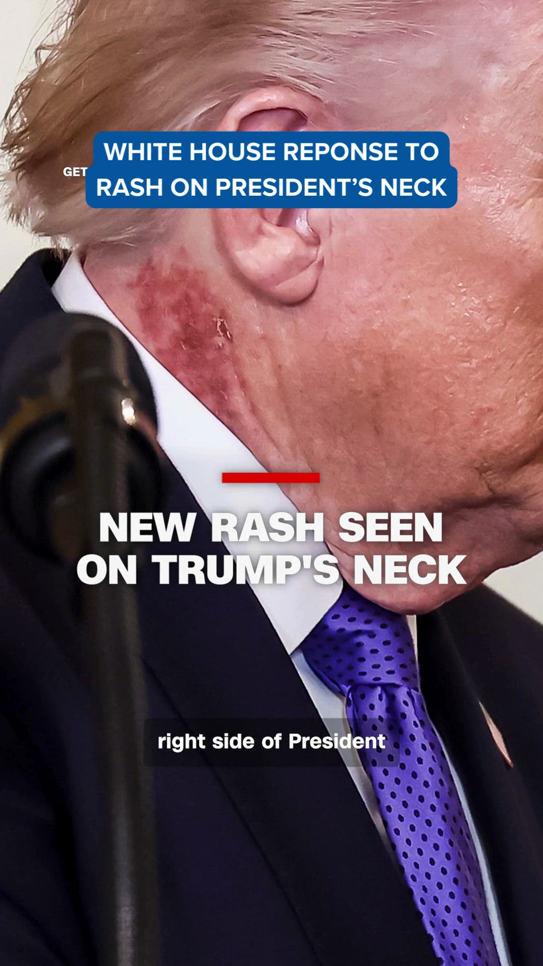 neck rash from dress shirt Why Are Collared Shirts So Uncomfortable? Enter The Flannel Shirt