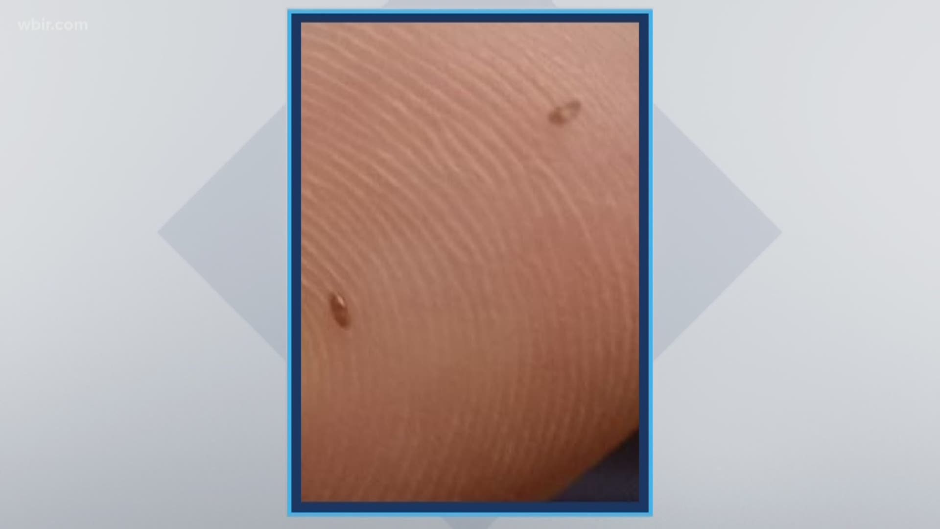 Melissa Brown said it started after her son went swimming in Harrison Bay State Park. Hours later, he started complaining about pain in his eyes. She took him to the hospital after noticing black dots. Eventually, those small bugs slid out of his eyes.