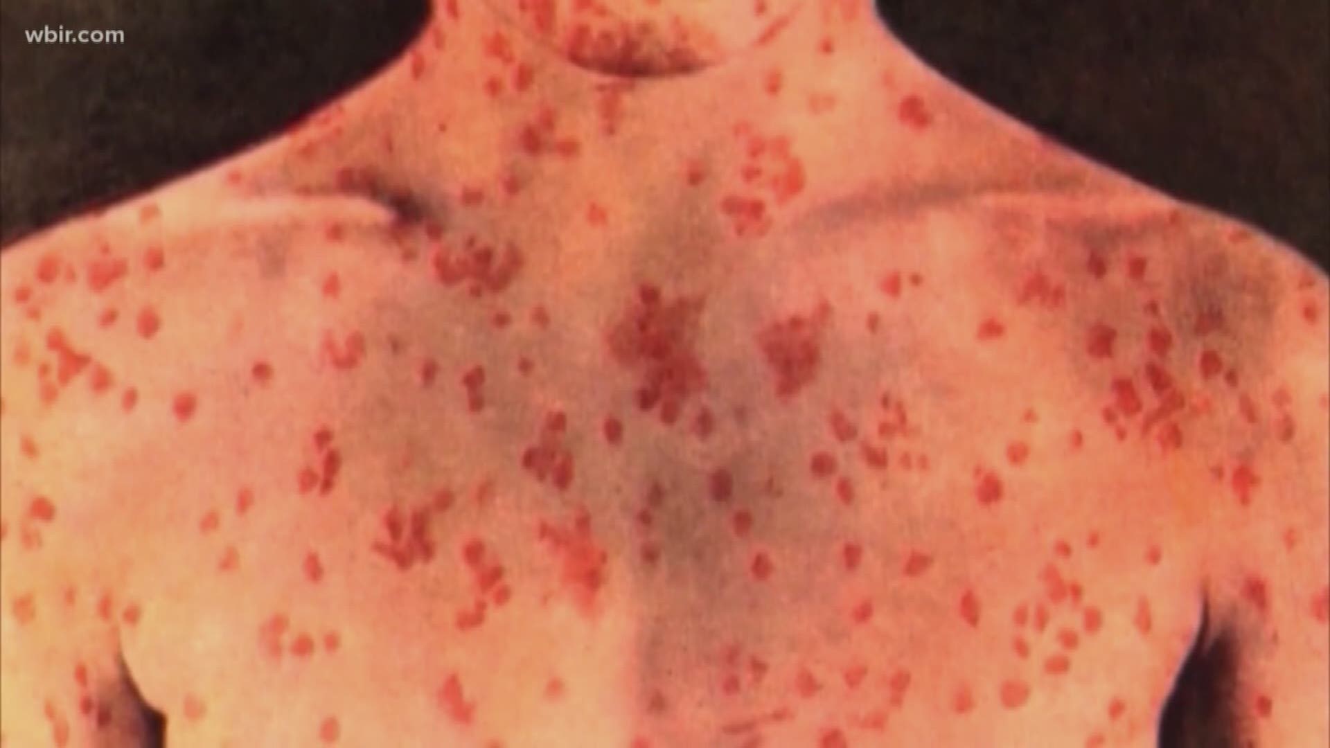 The state health department says it is no longer concerned about any new measles cases stemming from the original patient in Tennessee. The department says the investigation into the measles outbreak is still ongoing and it is monitoring some people who may have been exposed. There have been 5 measles cases in the state since the original patient brought it to Tennessee last month.