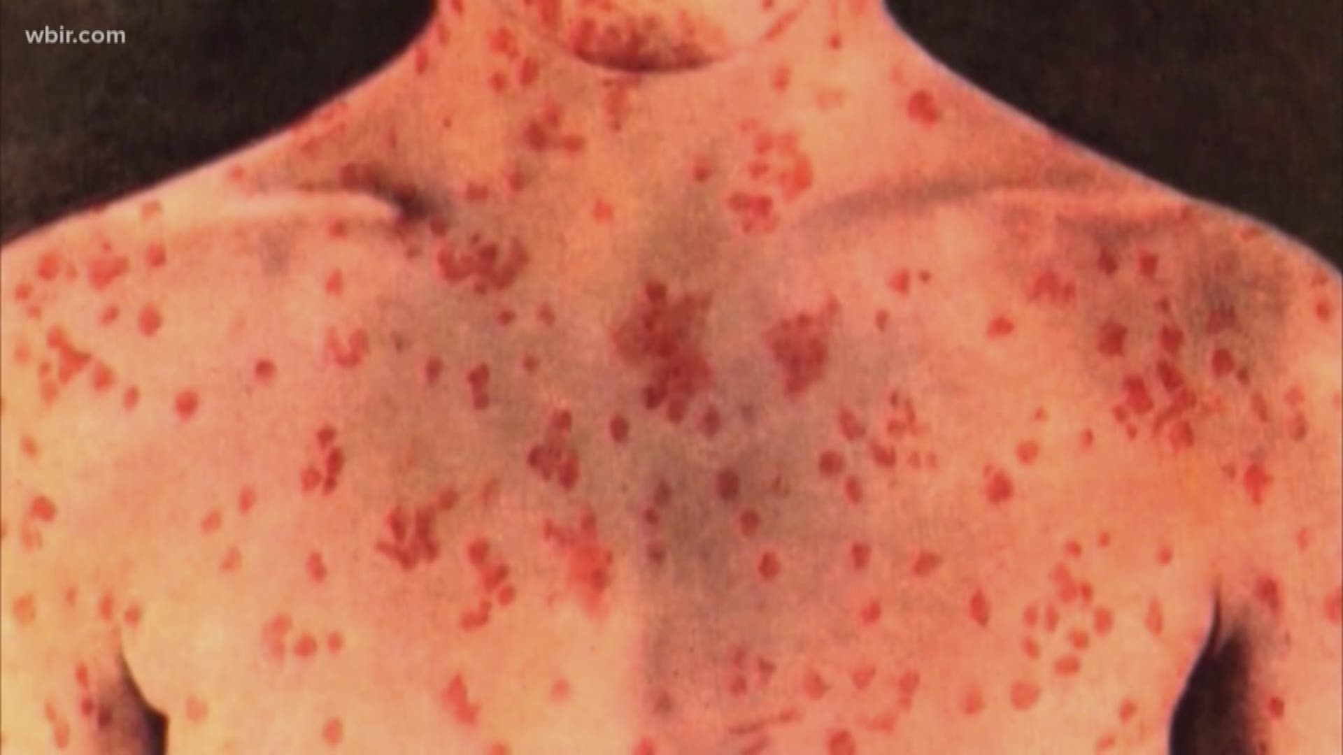 Two people the health department identified as contacts with the first case in the state now have the measles.