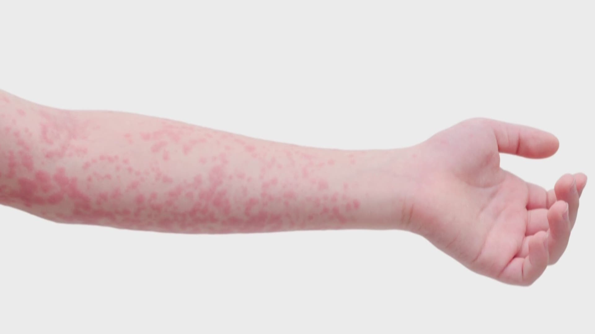 Health officials said East Tennessee now has one confirmed case of measles, which might not seem like a big issue until you learn how incredibly contagious the disease is.