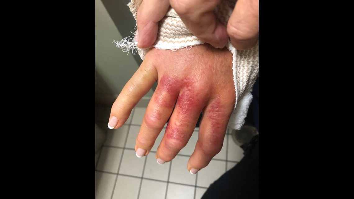 flesh eating disease finger