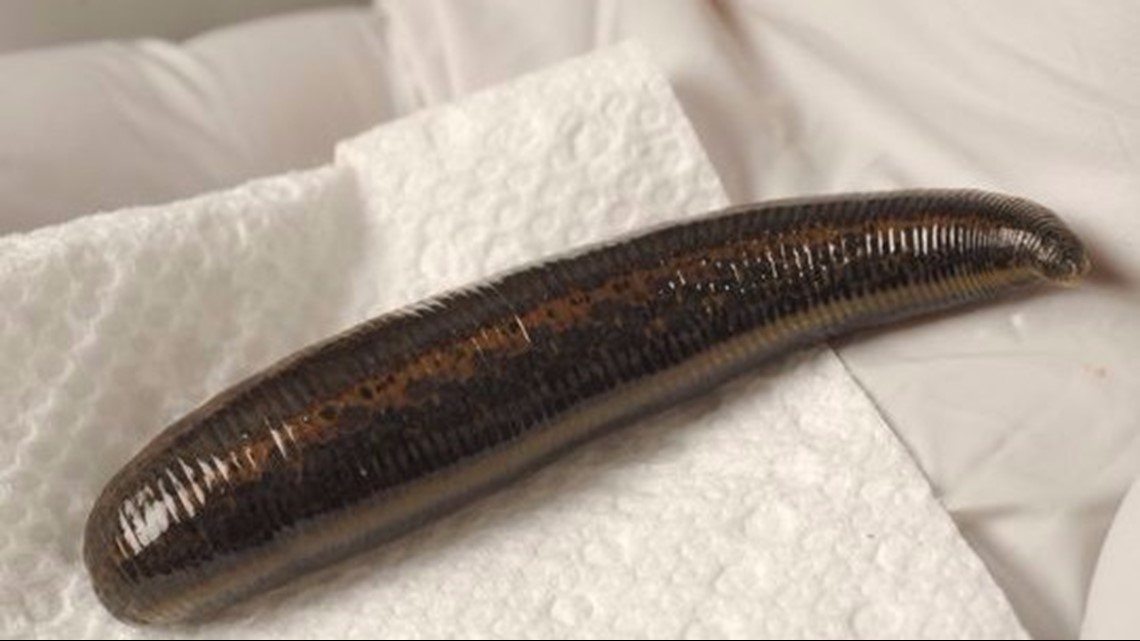 While gross, leeches aren't actually dangerous  News, Sports, Jobs -  Adirondack Daily Enterprise